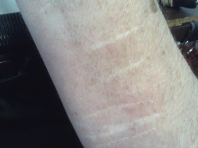 scars on wrists
